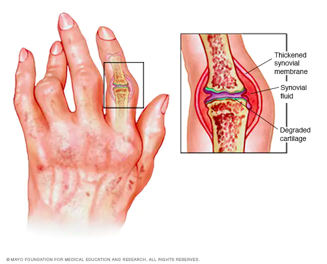 Rheumatoid Arthritis Diagram